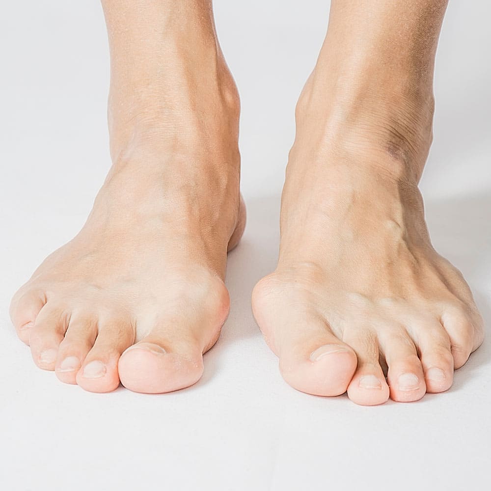 bunion foot problem