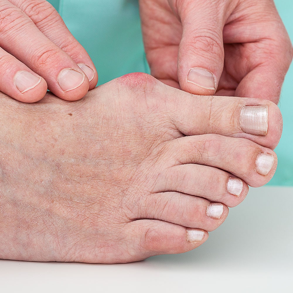 problems with foot - hallux