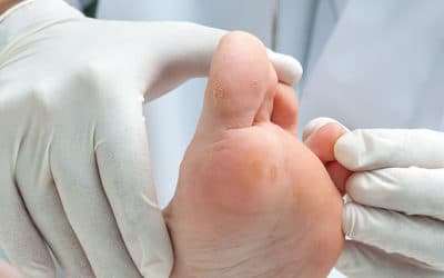 Identifying and Treating Hammertoes