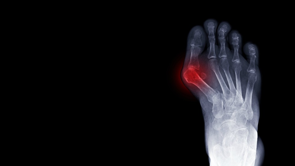 X-ray of a foot showing bunion that could be corrected with 3D bunion correction surgery