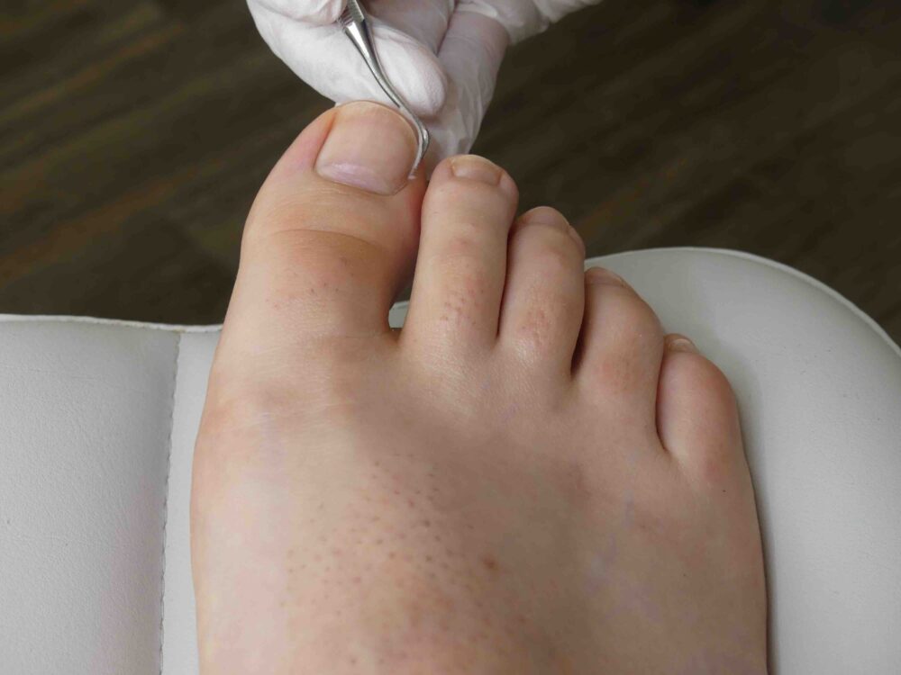 Treating ingrown toenail by removing part of the nail
