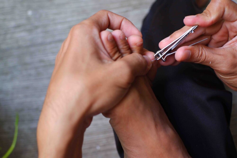 Trimming toenails properly to prevent ingrown toenails