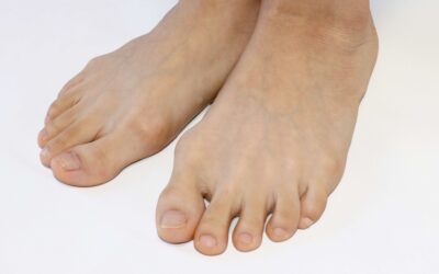 How Does Lapiplasty Compare to Traditional Bunion Surgery?