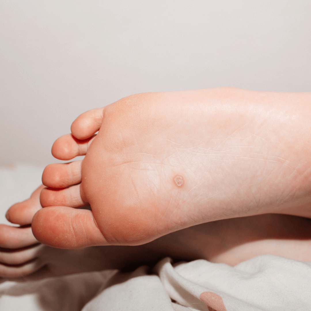 treatment for foot with plantar warts