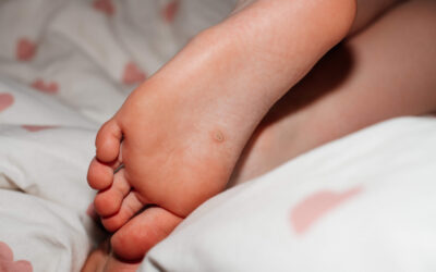 Are Plantar Warts Contagious?