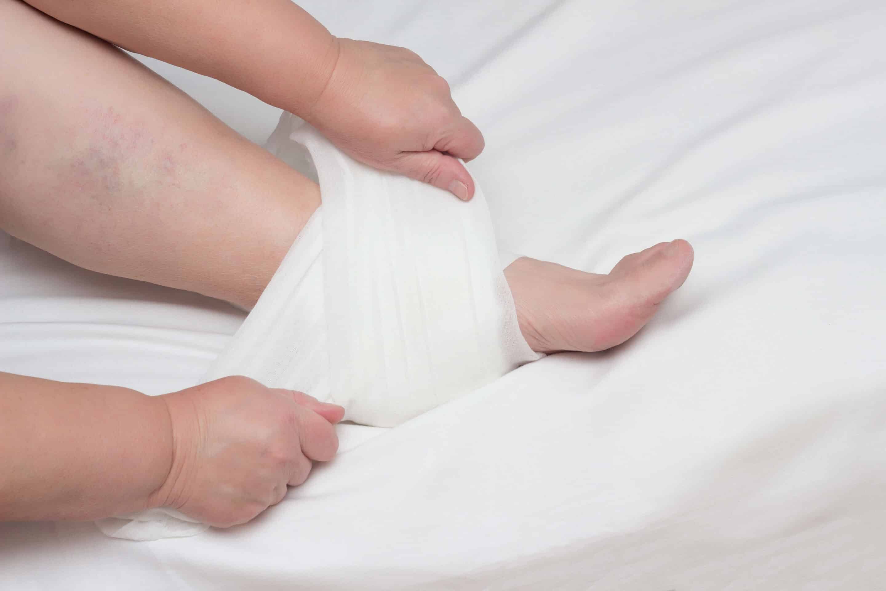 A woman sets up a warming and anti-inflammatory compress on the heel with heel spurs
