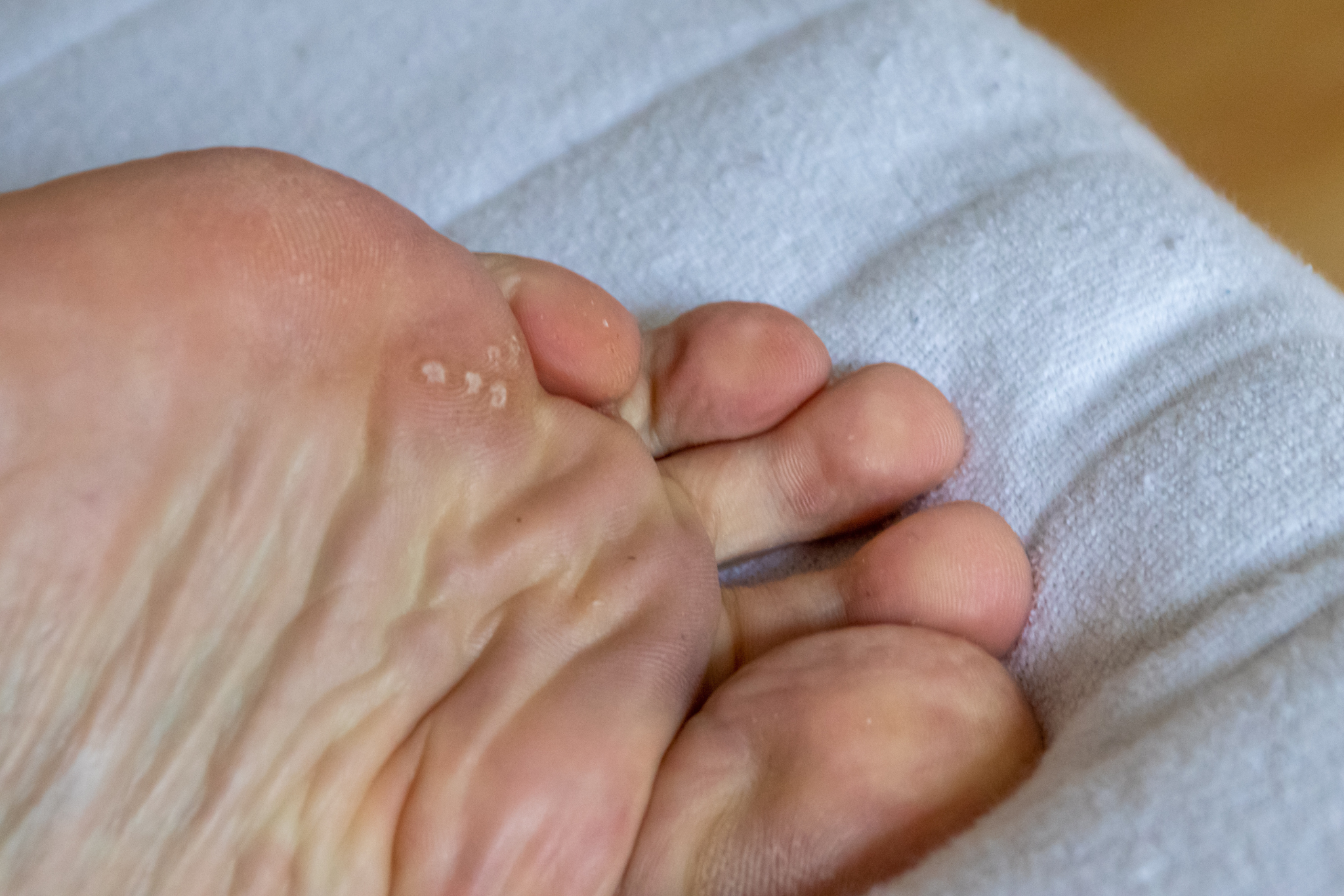 Foot with multiple warts