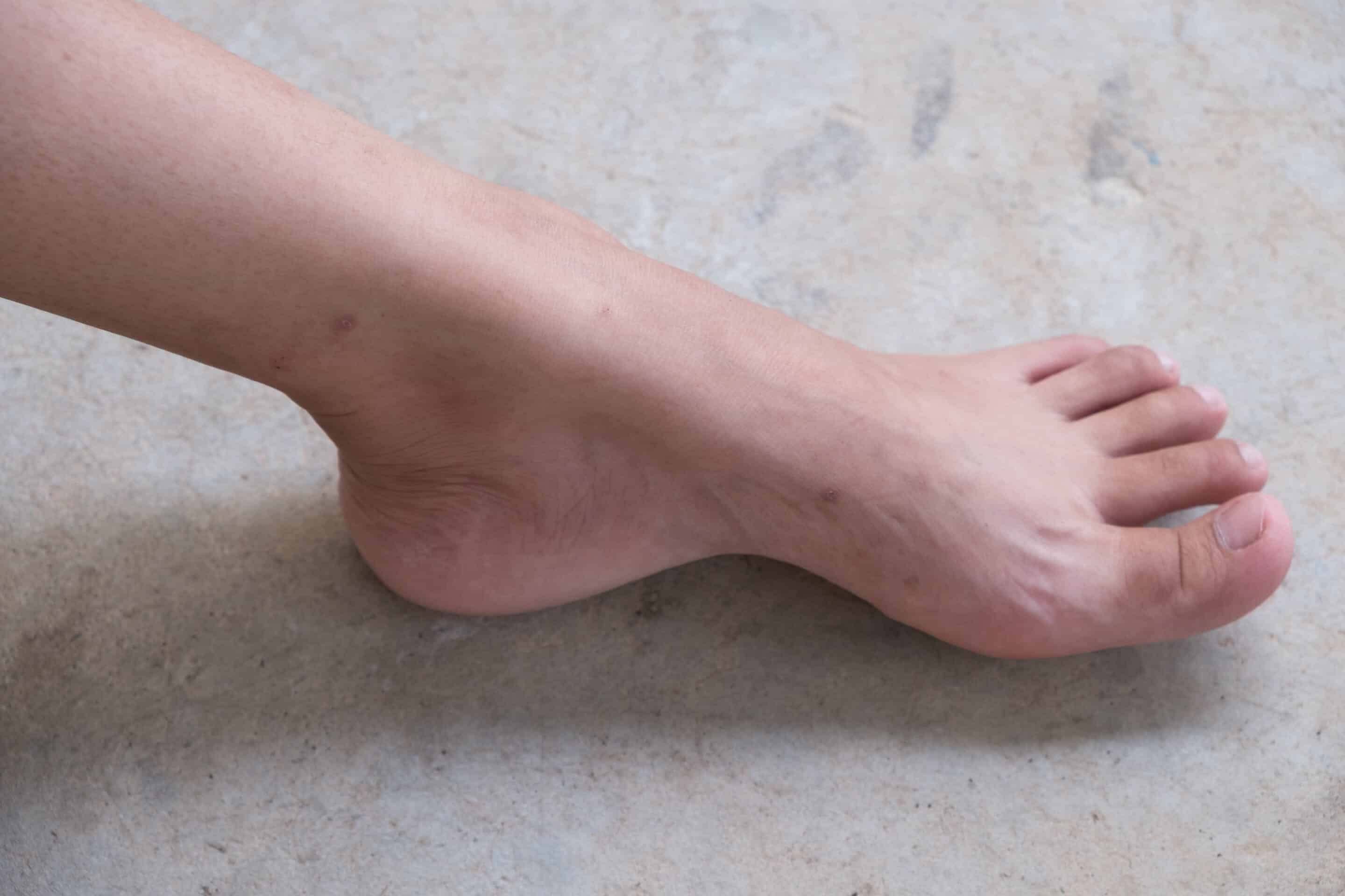 Person with painful toenails