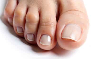 How to Know If You Have an Ingrown Toenail